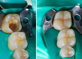 before and after tooth colored filling