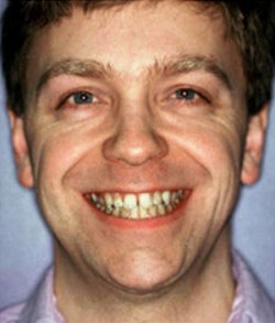 Man smiling before tooth alignment and teeth whitening