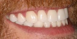 Closeup of man's smile after tooth alignment and teeth whitening
