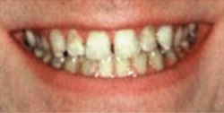 Closeup of man's smile before tooth alignment and teeth whitening