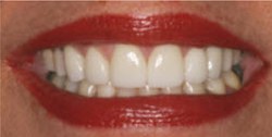 Closeup of woman's smile after gap between teeth is closed