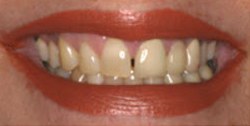 Closeup of woman's smile with gap between front teeth