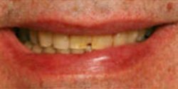 Closeup of man's smile with chipped tooth and yellow smile
