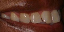 Closeup of woman's discolored smile