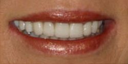 Closeup of woman's perfectly repaired and brightened smle