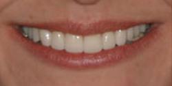 Closeup of woman's picture-perfect brilliant white smile