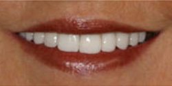 Closeup of older woman's brilliant white teeth